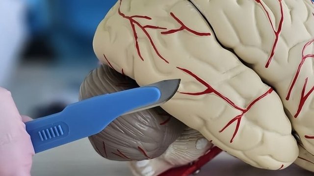imagen de una aneurisma en un cerebro de plástico