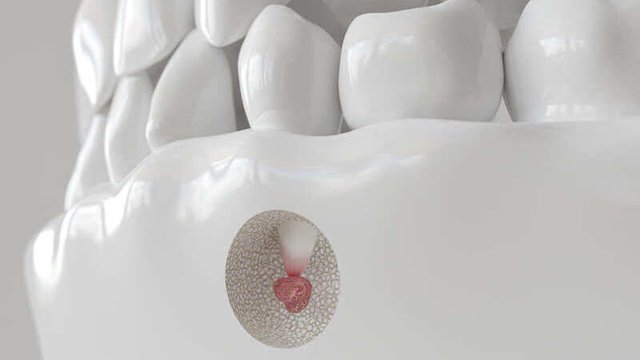 imagen de una apicectomía dental