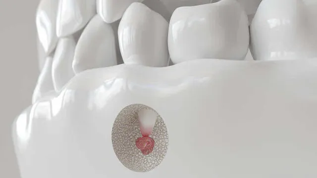 imagen de una apicectomía dental