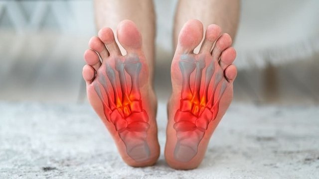 fascitis plantar imagen