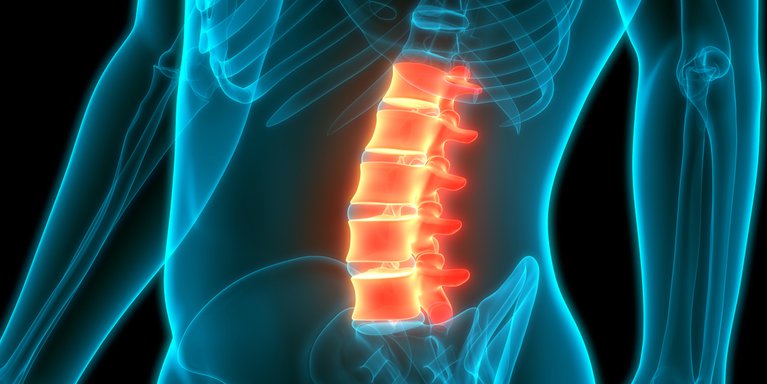 Qu Es La Hiperlordosis Lumbar Blog Ue