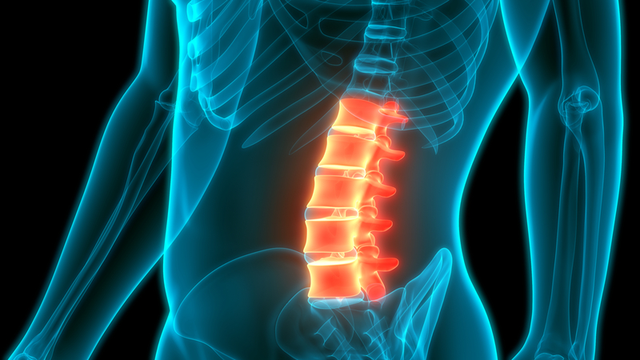 hiperlordosis-lumbar