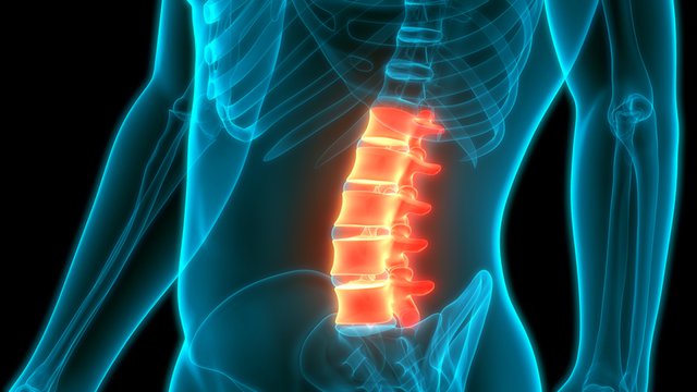 hiperlordosis-lumbar