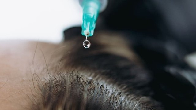 aplicación de mesoterapia capilar