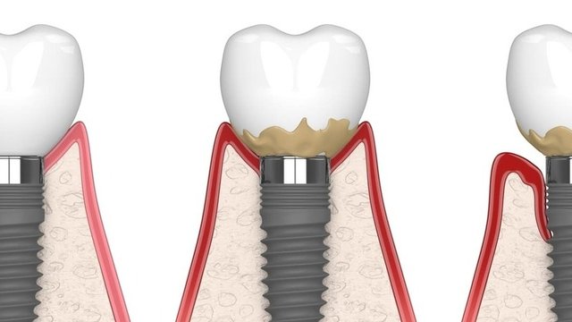 imagen de una periimplantitis