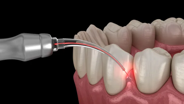que-es-periodoncia