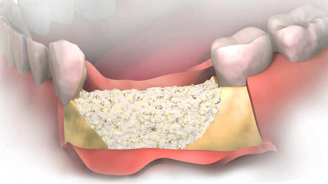 imagen de una regeneración ósea dental