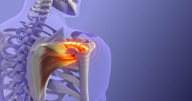 imagen digital de una tendinitis del maguito rotador