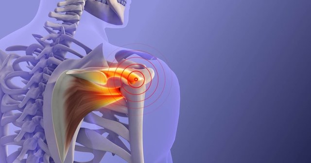 imagen digital de una tendinitis del maguito rotador