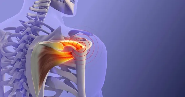 imagen digital de una tendinitis del maguito rotador