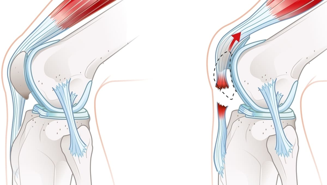 imagen digital de tendinitis rotuliana