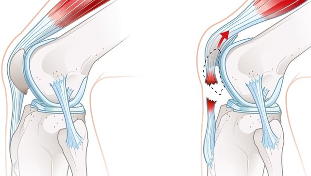 imagen digital de tendinitis rotuliana