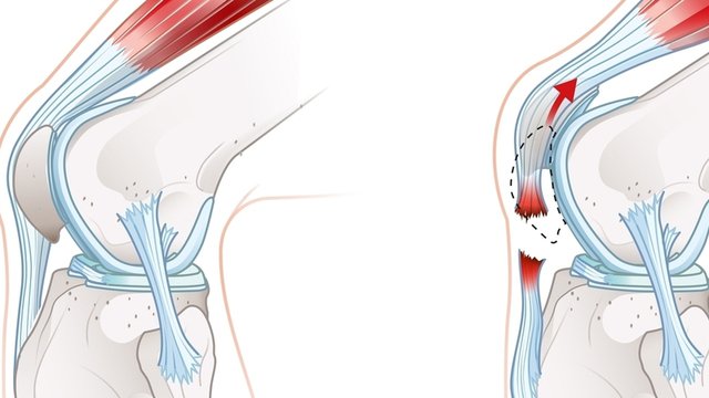 imagen digital de tendinitis rotuliana